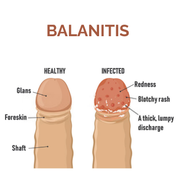 know-more-about-Balanitis-treatment-in-Thiruvananthapuram