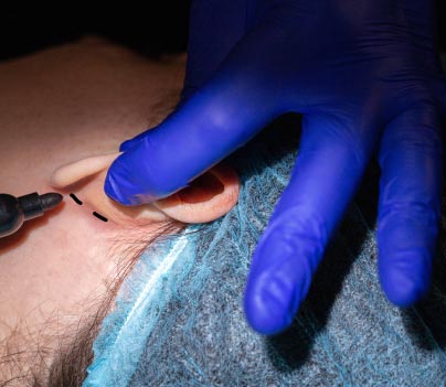 Otoplasty (Ear Reshaping cosmetic surgery)