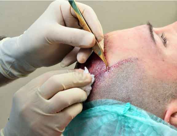 Removing hair follicles during Hair Transplantation in delhi