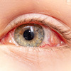 Redness in eye, because of a medical condition. 