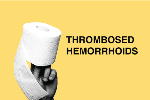 caused of thrombosed hemorrhoid