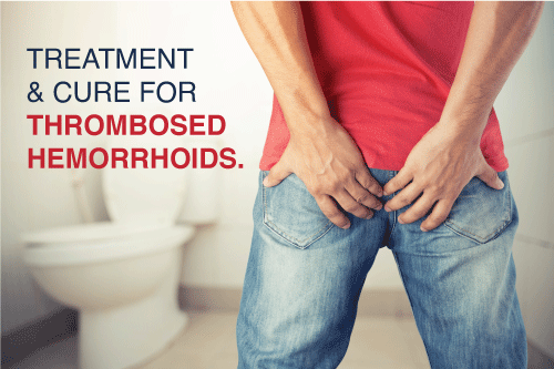 Treatment of thrombosed hemorrhoid
