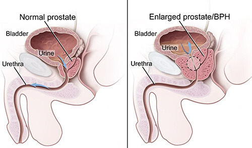Alpha Reductase Inhibitors