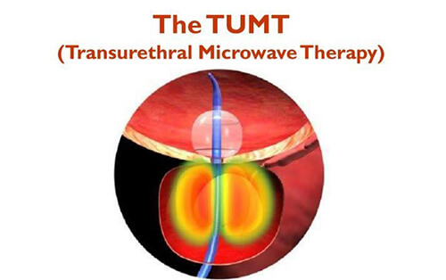 Transurethral microwave
