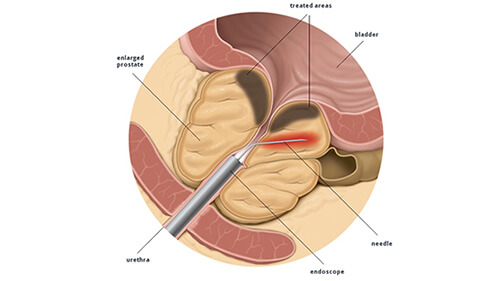 Transurethral needle