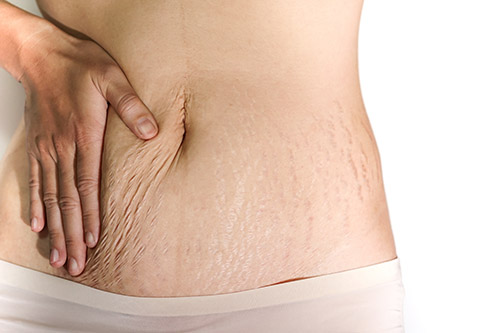 woman's stomach area with stretch marks