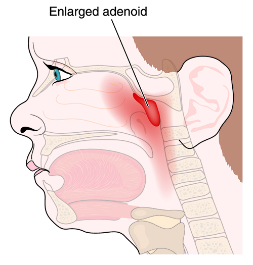 Adenoidectomy