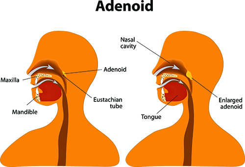 Enlarged adenoidectormy