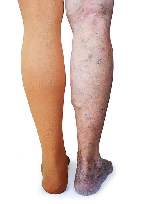 compression socks in varicose veins