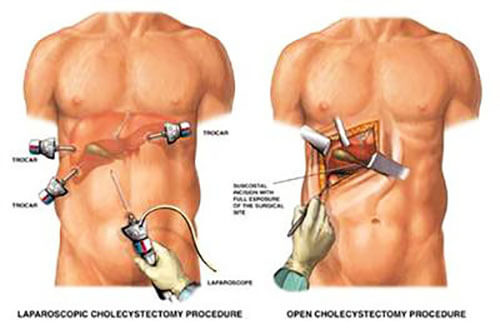 surgeon removes the gallbladder