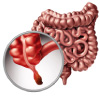 Inflammation of the appendix caused due to appendicitis