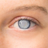 Close up of an individual's eye  having cataract