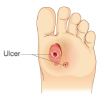 Ulcer on a patient's foot, caused due to uncontrolled or complicated diabetes