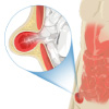 Illustration of Inguinal Hernia p[rotruding out of the abdomen area