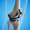 3-D illustration of the knee joint with artifical knee implant placed during the knee replacmenet surgery