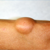 Lipoma on the arm of an individual