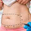 Black markings made on the stomach of an individual for liposuction procedure