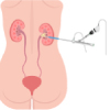 Illustration of PCNL surgery ( Percutaneous nephrolithotomy ) performed for kidney stone treatment.