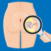 Doctor showing anal area of a patient with Pilonidal Sinus through magnifying glass