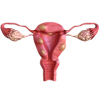 Uterus showing abnormal growths, showing the concept of endometriosis