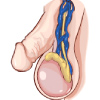Lateral view of male testes showing enlargement of the veins in scrotum