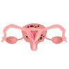Abnormal tissue growth in the uterine lining caused due to adenomyosis.