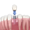 Graphic representation of a tooth implant 