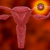 Illustration of ectopic pregnancy showing the fertilized egg implanted outside the uterus
