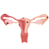 Illustration of uterus with abnormal growths, depicting endometriosis