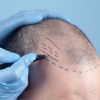 Doctor making markings for hair transplant surgery on a man's bald head 