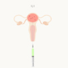 Illustration of Intrauterine insemination (IUI) for pregnancy where sperm is directly put inside the uterus