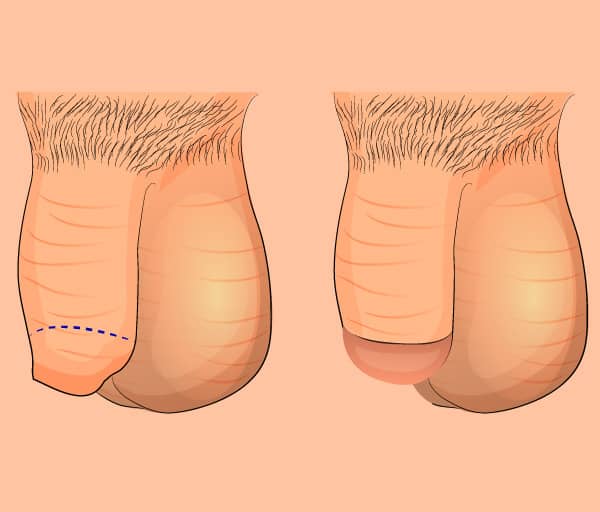 Circumcision Surgery in Kavali