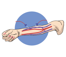 AV (arteriovenous) Fistula created in the arm for dialysis procedure 