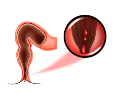 Tear in the lining of the anus caused due to anal fissure