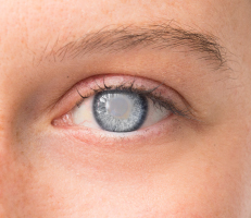 Close up of an individual's eye  having cataract