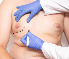 Doctor making markings for gynecomastia surgery under a man's breast who is suffering from enlarged breasts