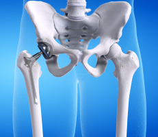 3-D illustration of the hip joint with artifical hip implant placed during the hip replacmenet surgery