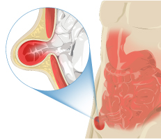 Illustration of Inguinal Hernia p[rotruding out of the abdomen area