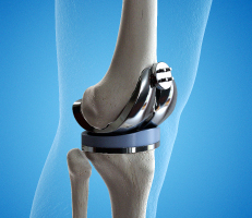 3-D illustration of the knee joint with artifical knee implant placed during the knee replacmenet surgery