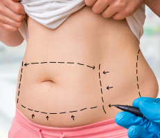 Black markings made on the stomach of an individual for liposuction procedure