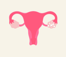 Uterus showing abnormalities in the ovaries, showing the concept of pcos/pcod (polycystic ovarian syndrome or disorder)