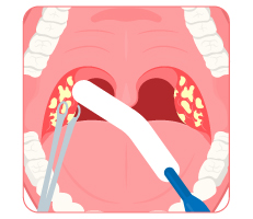 Illustration of tonsillectomy surgery performed on a patient 