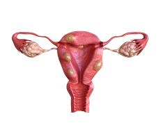 Uterus showing abnormal growths, showing the concept of endometriosis