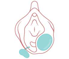 Bartholin cyst present on the vagina