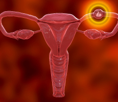 Illustration of ectopic pregnancy showing the fertilized egg implanted outside the uterus