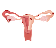 Illustration of uterus with abnormal growths, depicting endometriosis