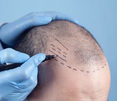 Doctor making markings for hair transplant surgery on a man's bald head 