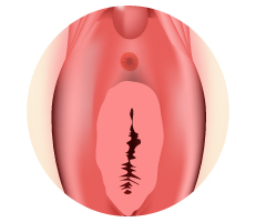 Illustration of a hymen and vagina after hymenoplasty surgery 