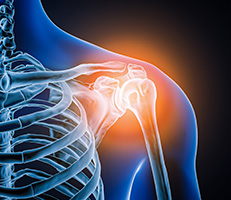 Representation of shoulder joint replacement