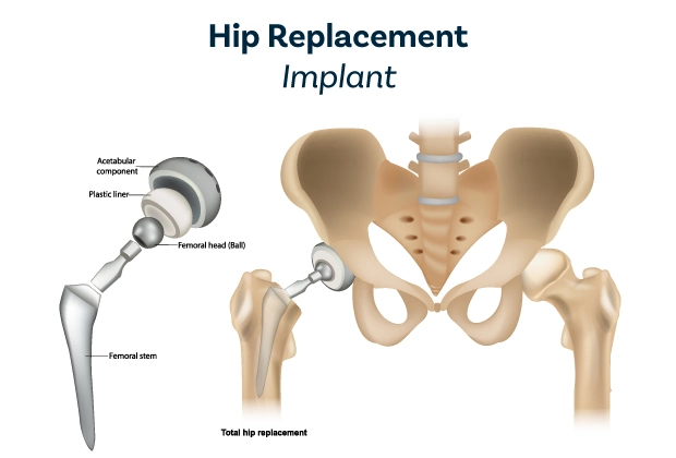 Hip replacement with Implant